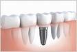 Implante dentário Tipos, quando é indicado e como é feit